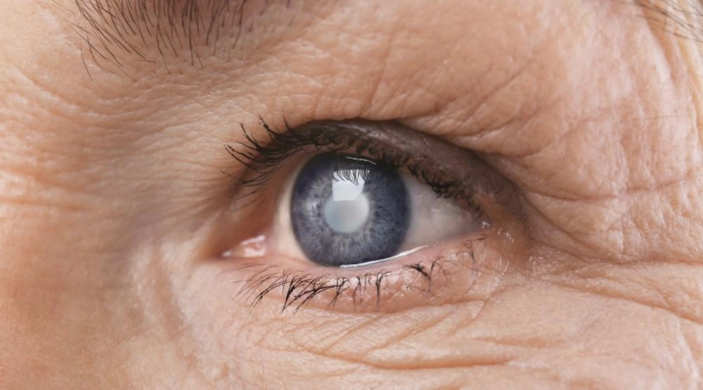 4 Telltale Signs of Cataracts