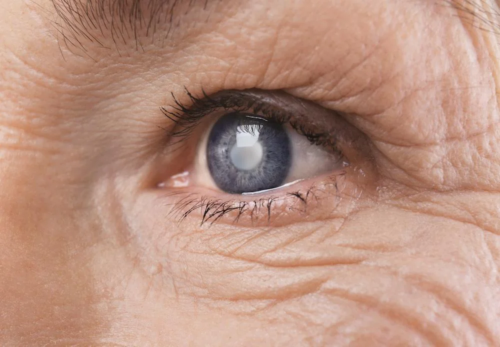I'm Nervous About Cataract Surgery What Can I Expect